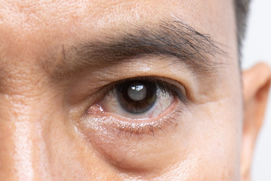 Cirurgia de catarata refrativa com Dr. Wagner Gomes em Belo Horizonte